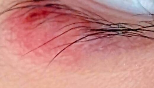 ものもらいの一種「霰粒腫（さんりゅうしゅ）」は、完治に2週間から数ヶ月かかる